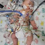 Breastfeeding through open heart surgery